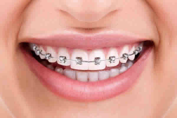 Plano odontológico cobre colocação de aparelho dental?