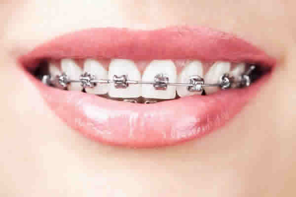 Como funciona a colocação de aparelho nos dentes pelo plano odontológico?